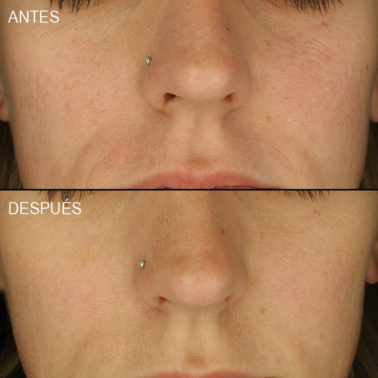 Eficacia Before & After All
