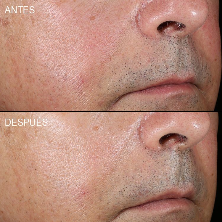 Eficacia clínica atobalm