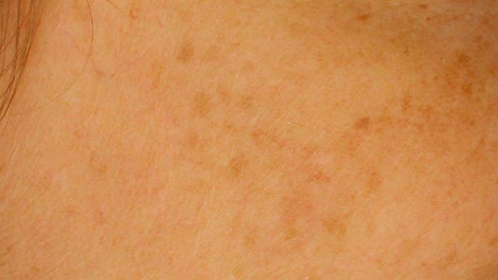 Alcohol en cosmética y su relación con manchas y melasma