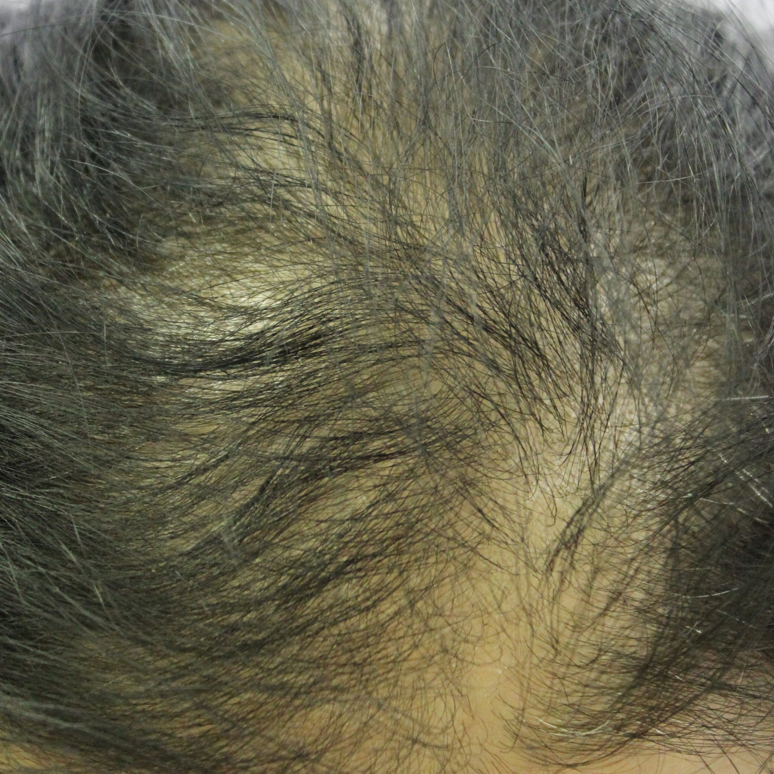 Eficacia antes de usar Hair Re-Genesis sobre la longevidad y el envejecimiento capilar